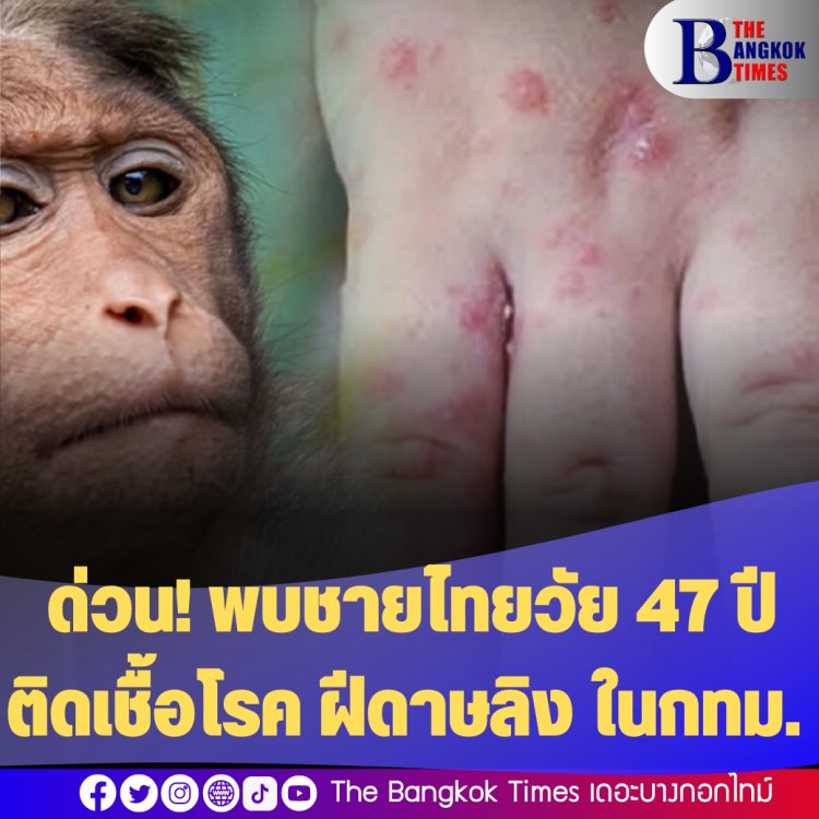 ด่วน! พบชายไทยวัย 47 ปี ติดเชื้อโรค ฝีดาษลิง ในกทม.
