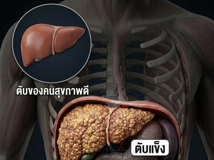 “ตับแข็งได้ยังไง”...!!